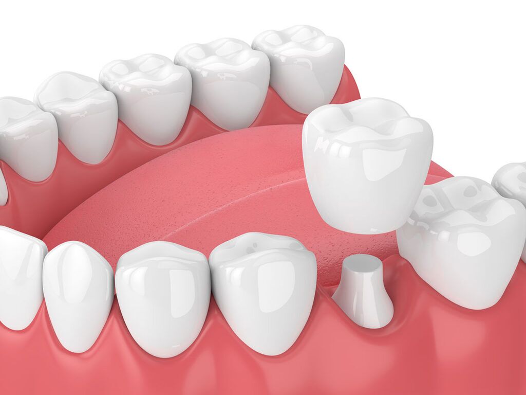 Dental care image for Understanding Dental Crowns in Summit, NJ: Rebuilding Strength and Comfort Dental care image for Understanding Dental Crowns in Summit, NJ: Rebuilding Strength and Comfort