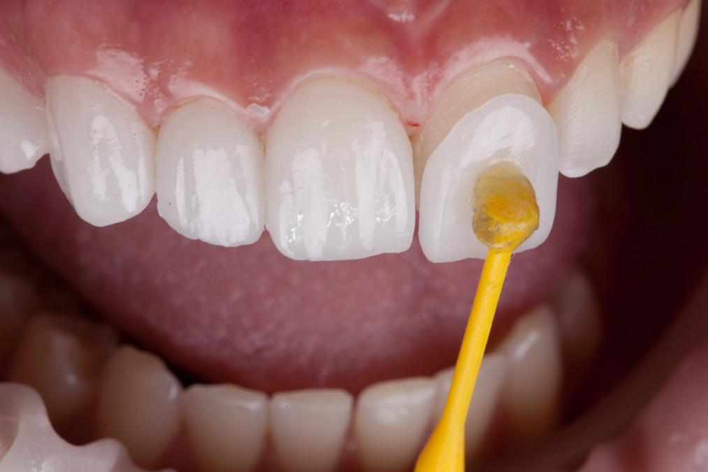 Summit Family & Cosmetic Dentistry image for What Happens When Small Details Come Together Beautifully?