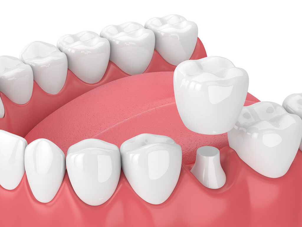 Dental care image for Understanding Dental Crowns in Summit, NJ: Rebuilding Strength and Comfort