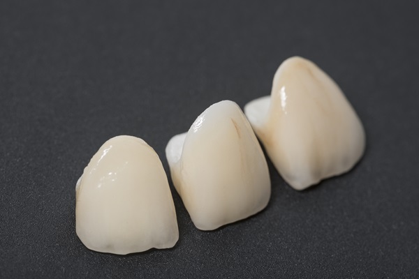 How Dental Crowns Are Bonded To A Tooth