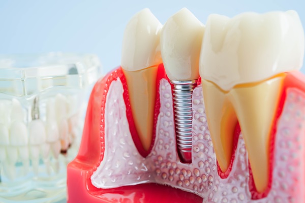 Recovery Tips After Getting Dental Implants